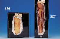 Demonstrationsmodell für Syphilis, um 1900, Wachsmodell eines Unterschenkels unter Glas, 33 x 27 cm, l. Alterssp.