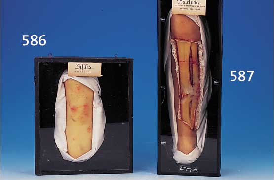 Demonstrationsmodell für Syphilis, um 1900, Wachsmodell eines Unterschenkels unter Glas, 33 x 27 cm, l. Alterssp.