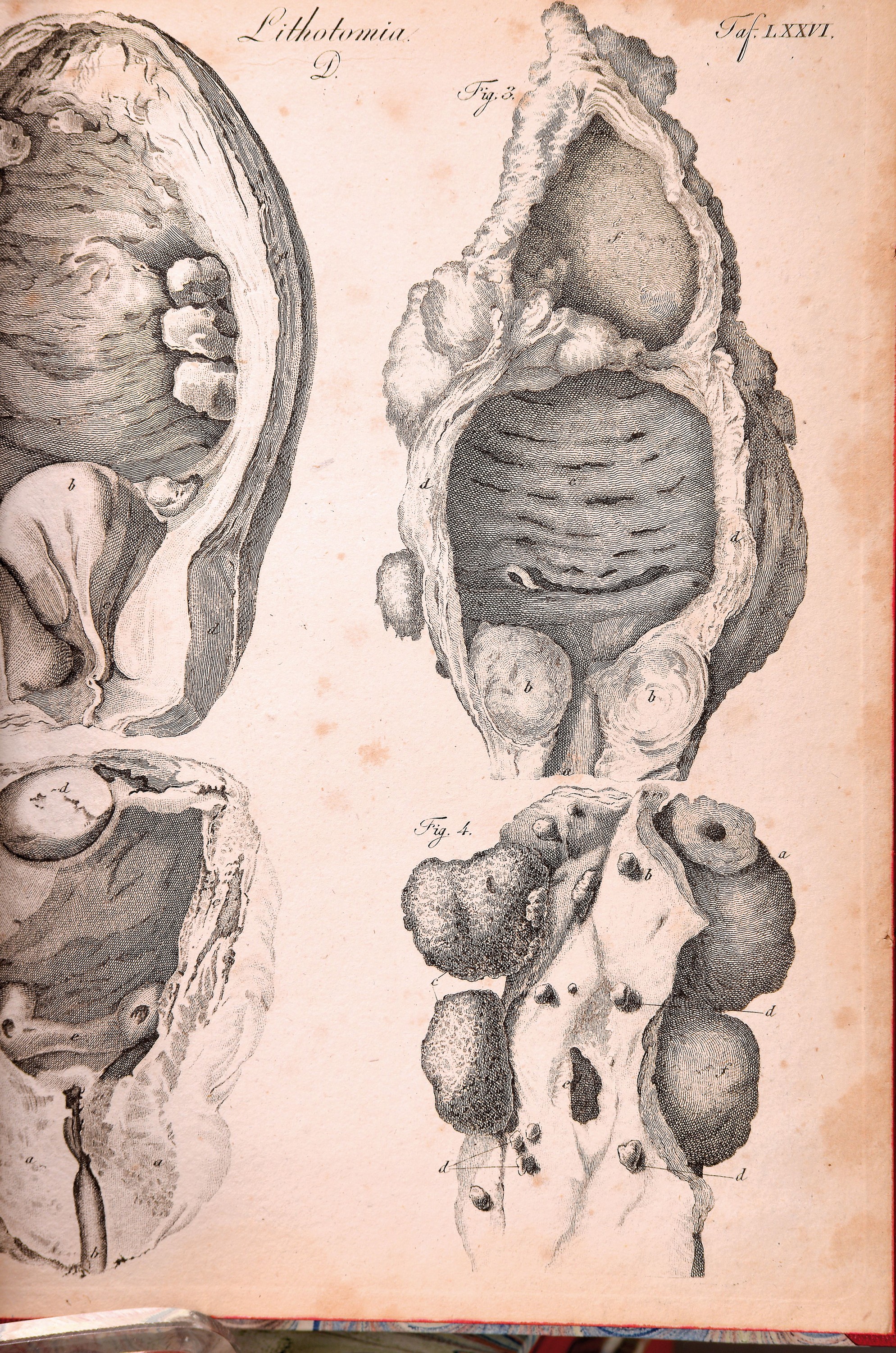 Detail a: Ludwig Friedrich von Froriep (1779-1847): Chirugische Kupfertafeln. Eine auserlesene Sammlung der nöthigsten Abbildungen von äusserlich sichtbaren ...
